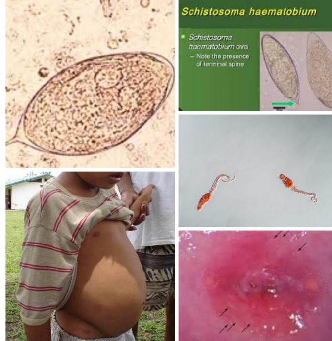 Maladies Tropicales Négligées  : La schistosomiase,  une maladie aux conséquences multiples à éviter  Sa lutte : une priorité pour le Bénin