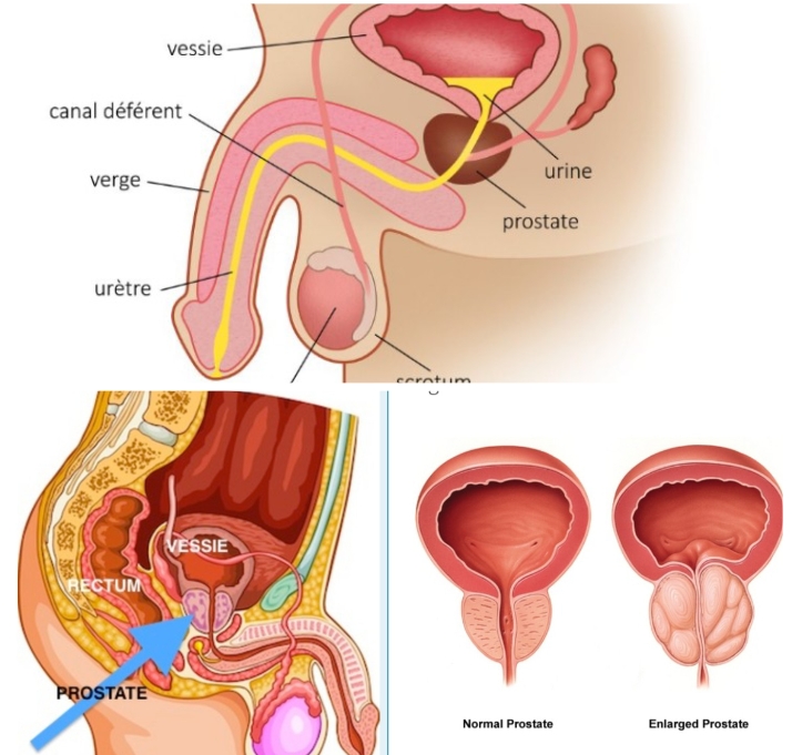 Cancer de la prostate : quand et comment commencer la prévention ?